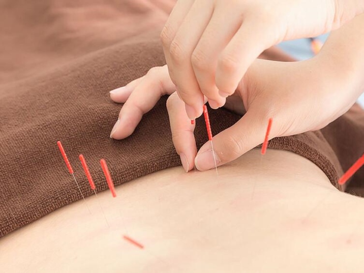 Chinese Acupuncture Therapy 